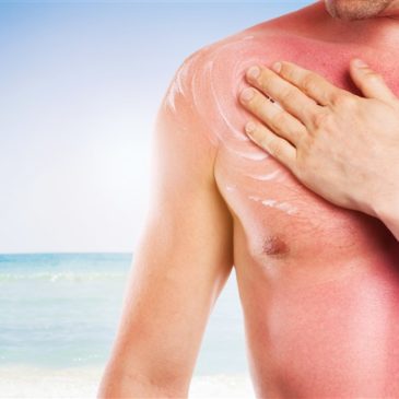 Can you have a massage with sunburn?