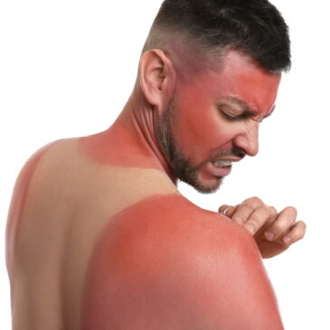 Can you get a massage with sunburn?